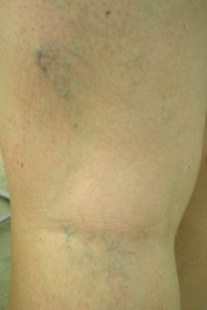 VARICES QUE SON LAS VARICES Clínica Doctora Carmen Traseira