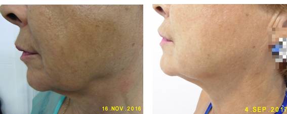 Remodelación Del óvalo Facial Con Láser Dra Carmen Traseira 8199